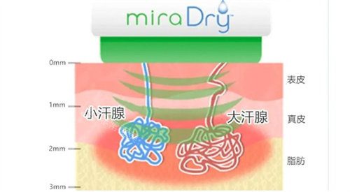 清新微波治疗原理