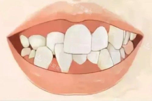 牙齿畸形卡通模型图