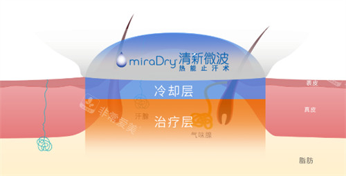 miraDry清新微波作用层次