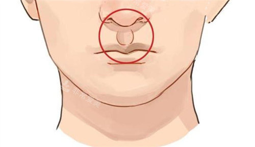 人中加深手術(shù)后 人中加深手術(shù)后