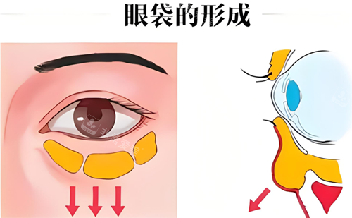 眼袋形成 眼袋形成