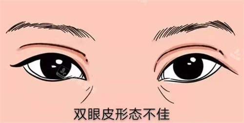 修復(fù)雙眼皮 修復(fù)雙眼皮