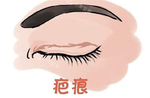 雙眼皮術(shù)后疤痕 雙眼皮術(shù)后疤痕