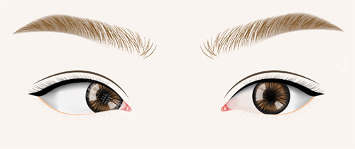 斜视眼睛和正常眼睛