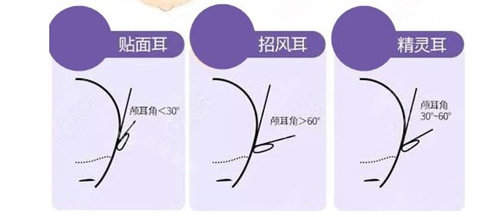 貼面耳招風(fēng)耳精靈耳區(qū)別 貼面耳招風(fēng)耳精靈耳區(qū)別