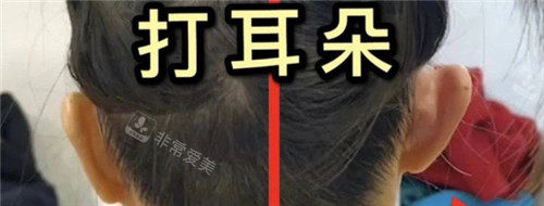 精靈耳注射圖 精靈耳注射圖