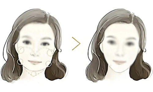 面部吸脂對(duì)比 面部吸脂對(duì)比