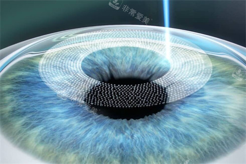 全飛秒手術(shù)動畫圖 全飛秒手術(shù)動畫圖