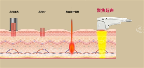 尖峰超声王作用皮肤层次透视图