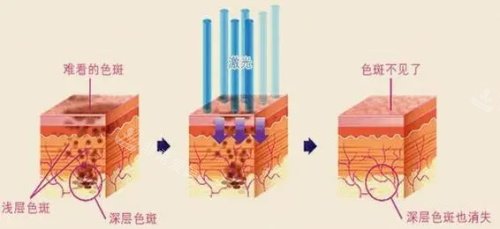 激光祛斑治疗示意图 激光祛斑治疗示意图