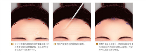 內(nèi)視鏡提眉手術(shù)動畫演示圖 內(nèi)視鏡提眉手術(shù)動畫演示圖