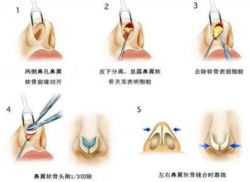 鼻翼手術(shù)步驟圖 鼻翼手術(shù)步驟圖