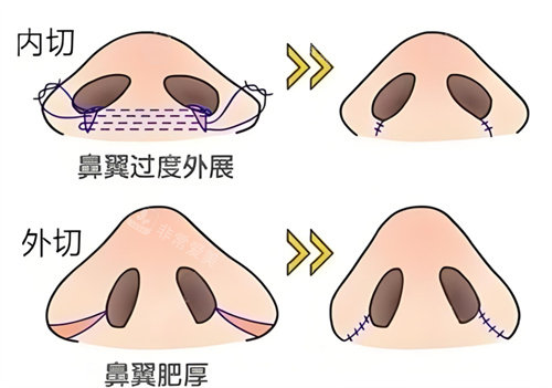 鼻翼縮小內(nèi)切外切對比 鼻翼縮小內(nèi)切外切對比