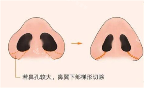 鼻翼縮小手術(shù)操作 鼻翼縮小手術(shù)操作
