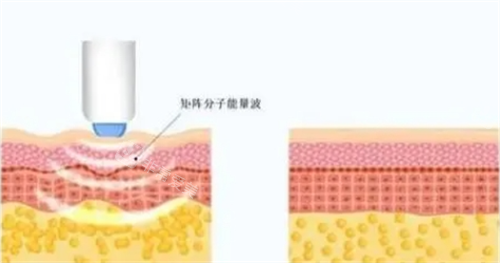 熱瑪吉項目皮膚剖面圖 熱瑪吉項目皮膚剖面圖