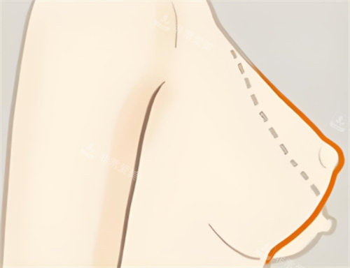 乳房下垂矯正輪廓對(duì)比 乳房下垂矯正輪廓對(duì)比