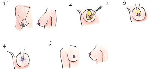 乳房下垂矯正術(shù)過程 乳房下垂矯正術(shù)過程