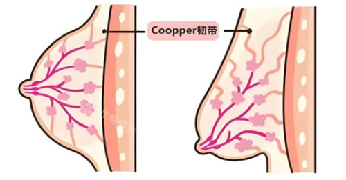 乳房下垂韌帶組織對(duì)比 乳房下垂韌帶組織對(duì)比