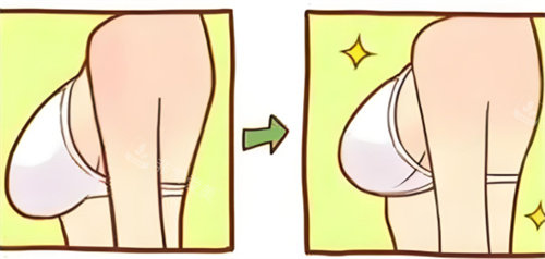 乳房下垂內(nèi)衣穿著對(duì)比 乳房下垂內(nèi)衣穿著對(duì)比