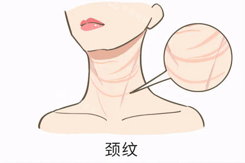 頸紋卡通示意圖 頸紋卡通示意圖
