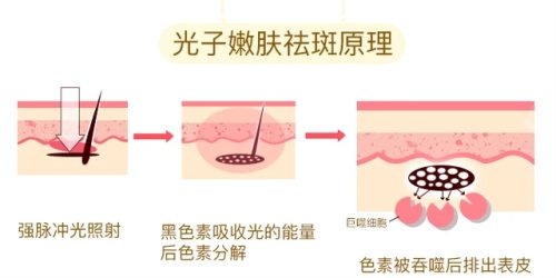 光子嫩膚的祛斑原理 光子嫩膚的祛斑原理