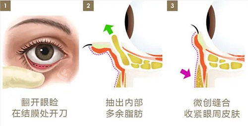 內(nèi)切去眼袋 內(nèi)切去眼袋