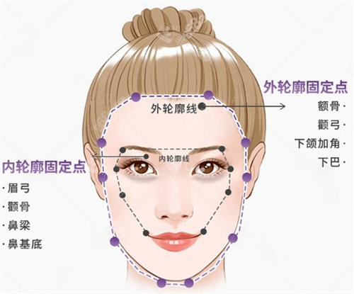 轮廓固定图示