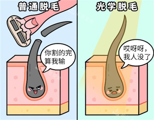 激光脫毛和普通刮毛的區(qū)別 激光脫毛和普通刮毛的區(qū)別