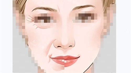 拉皮手術(shù)前后對比示意圖.jpg 拉皮手術(shù)前后對比示意圖.jpg