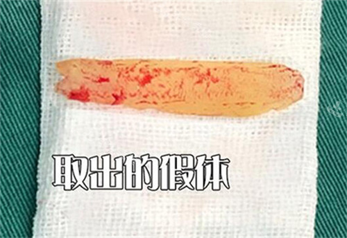 鼻假體取出改善圖照片 鼻假體取出改善圖照片