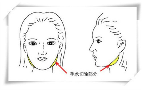下颌角截骨手术 下颌角截骨手术
