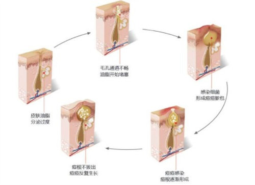 痘坑怎么生成的 痘坑怎么生成的