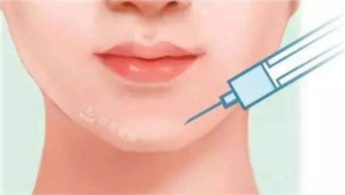 玻尿酸豐下巴的示意圖 玻尿酸豐下巴的示意圖