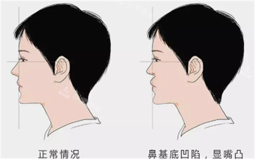 鼻基底凹陷對面部的影響圖解 鼻基底凹陷對面部的影響圖解