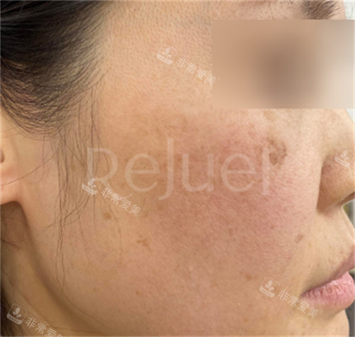 Rejuel Clinic東城路色斑治療前 Rejuel Clinic東城路色斑治療前