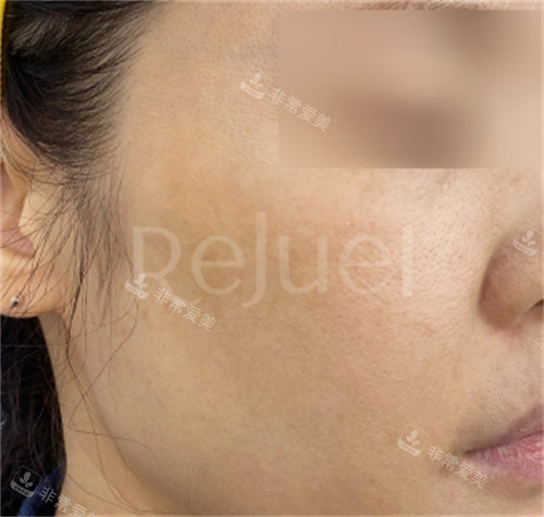 Rejuel Clinic東城路色斑治療后 Rejuel Clinic東城路色斑治療后
