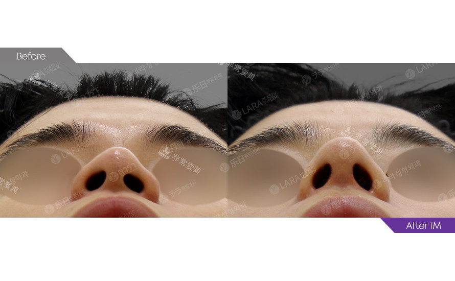 鼻尖 鼻尖