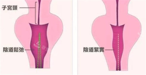 生物束帶緊縮術(shù)對(duì)比 生物束帶緊縮術(shù)對(duì)比