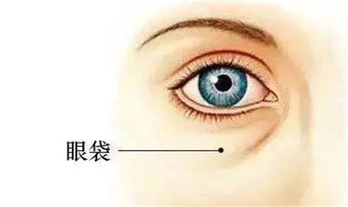 眼袋 眼袋