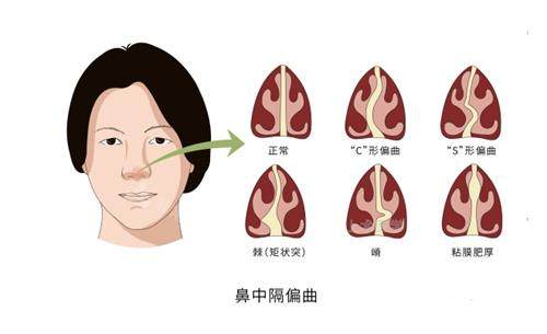 鼻中隔偏曲的类型