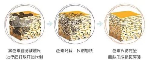 激光祛斑的原理 激光祛斑的原理