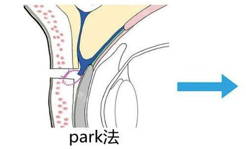 Park法雙眼皮 Park法雙眼皮