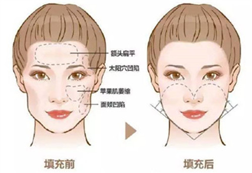 自体脂肪填充前后对比图 自体脂肪填充前后对比图