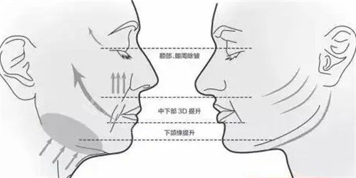 面部提升三大部位 面部提升三大部位