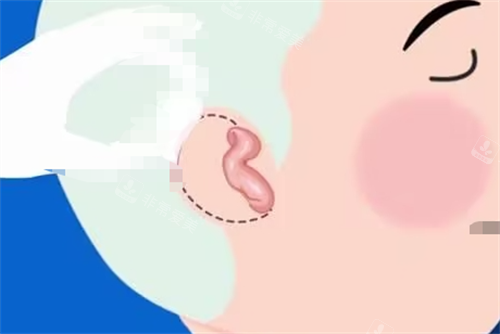 儿童耳再造耳畸形展示