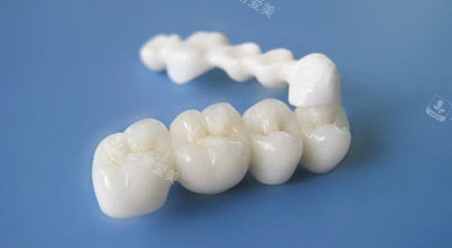 全瓷牙半口展示图