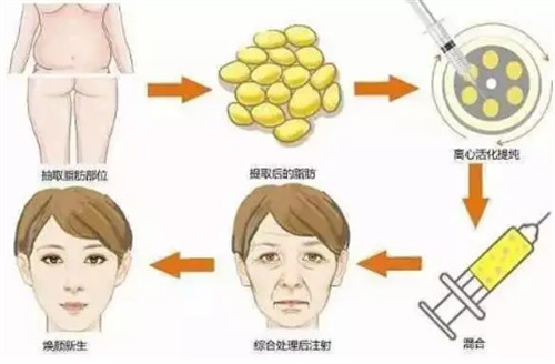 自體脂肪填充過程圖解 自體脂肪填充過程圖解