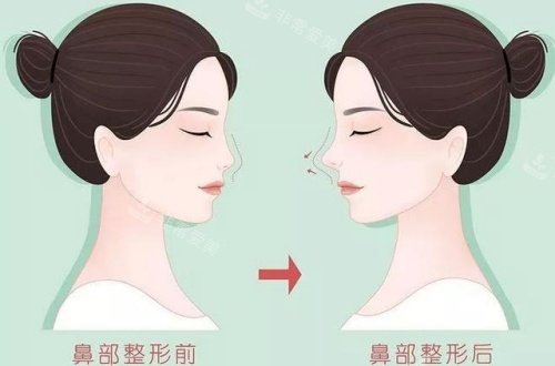 隆鼻术后漫画示意图