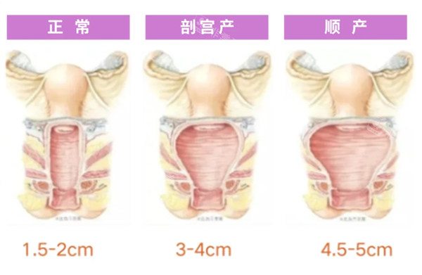 正常陰道和松弛對比照片