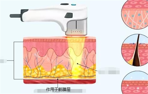 超聲治療作用于筋膜層動畫展示